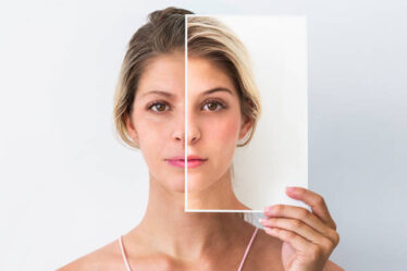 How Isotretinoin Transforms Your Skin: Before and After