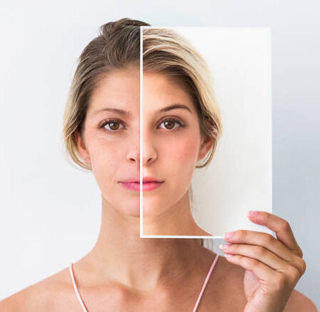 How Isotretinoin Transforms Your Skin: Before and After